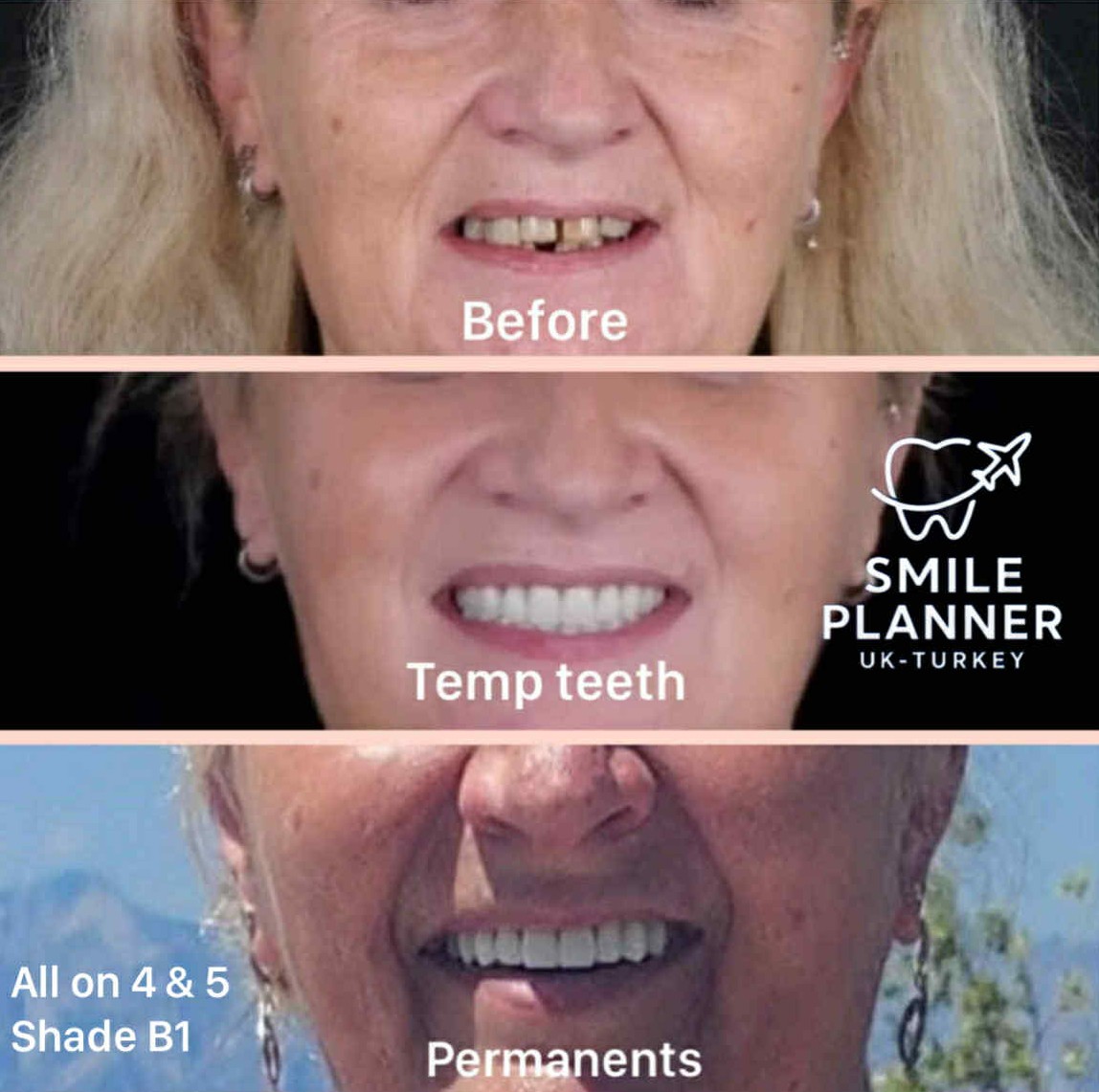 UK patient smile transformation all-on-5 in Turkey